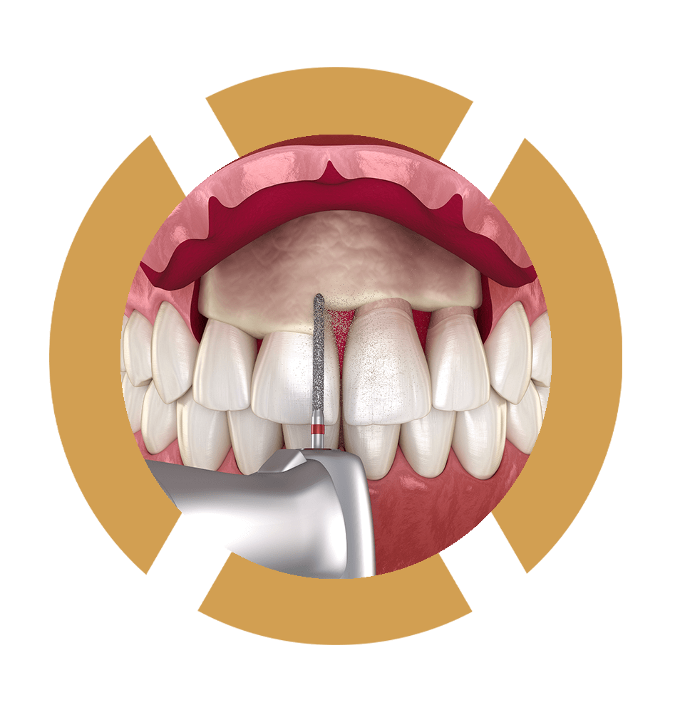 crown lengthening frame