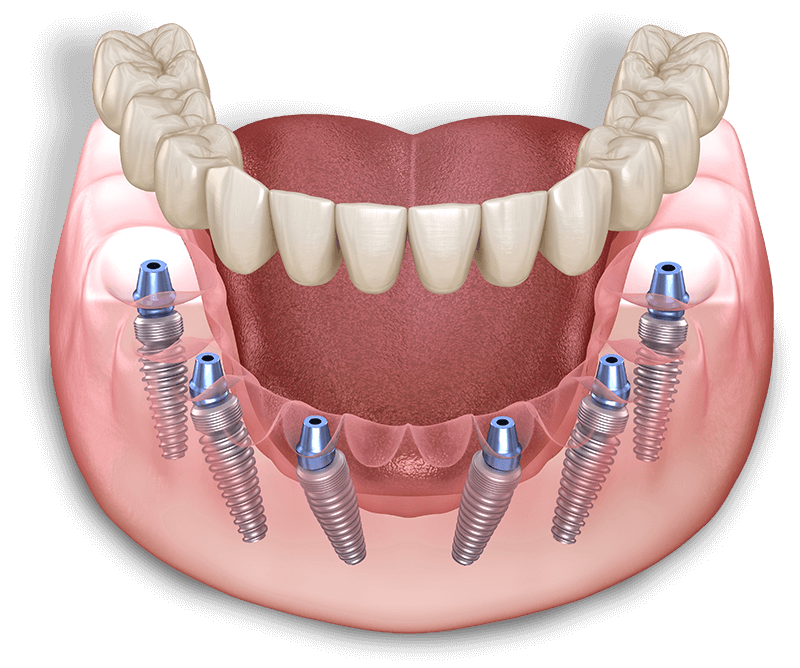 full arch dental model illustration