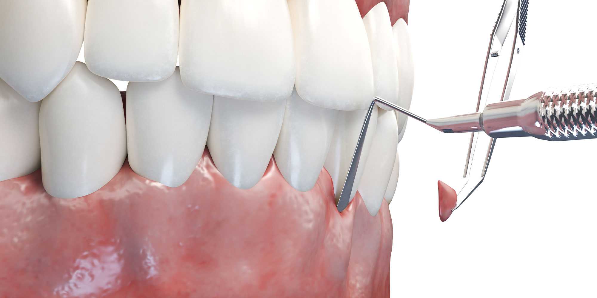 illustration of gum graft