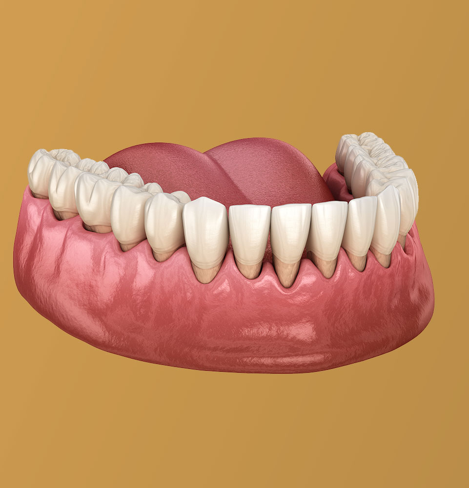 illustration of gum recession