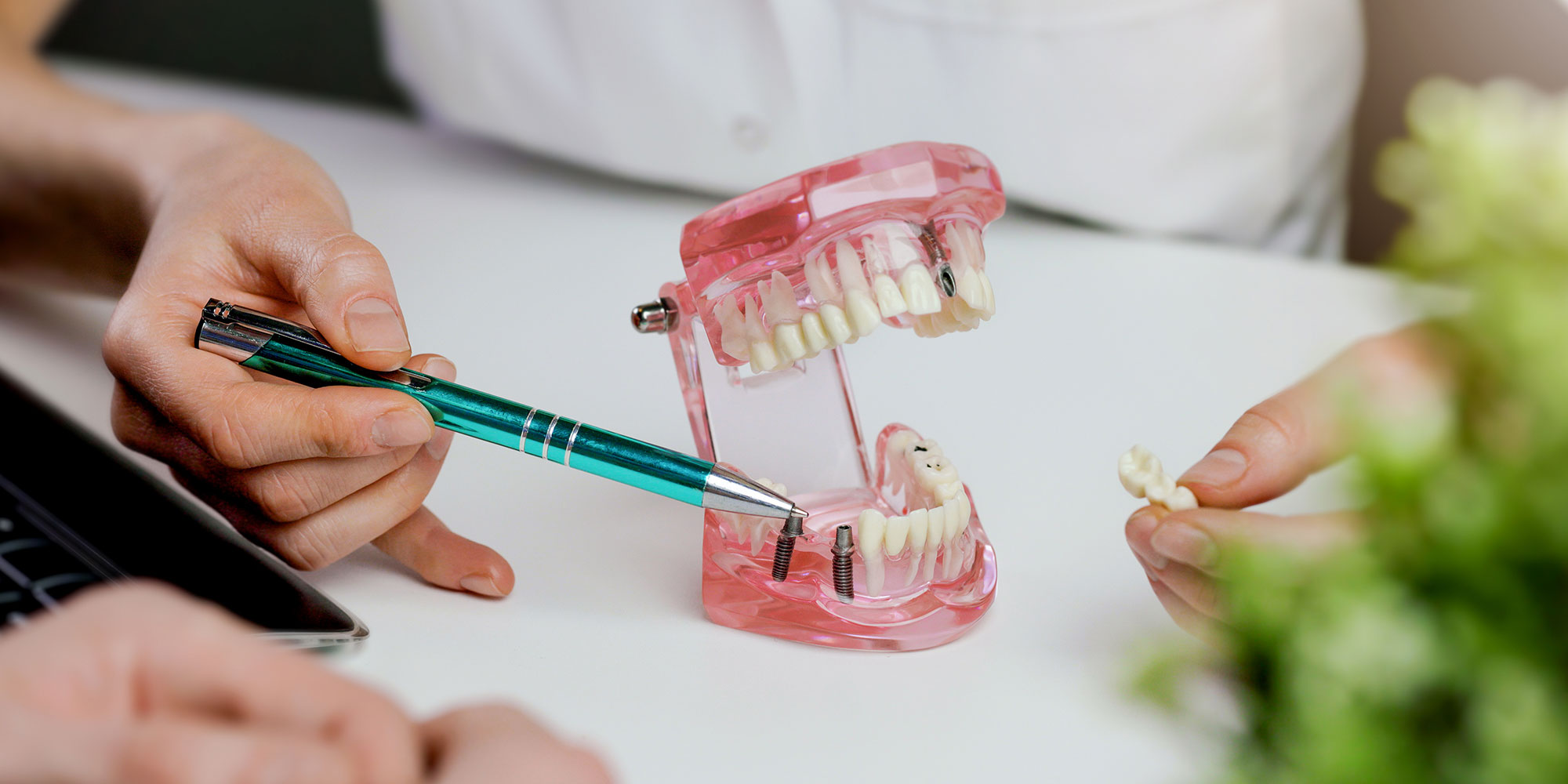 close up of a model mouth with implants inserted within