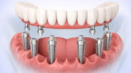 3 on 6 dental implant