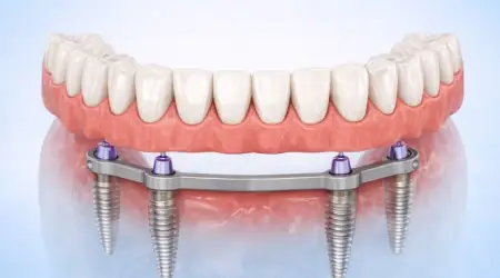 all on 4 dental implant