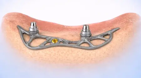 subperiosteal dental implant