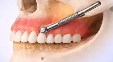 zygomatic dental implant